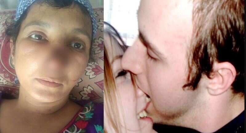 வரதட்சணை கொடுமை.. மனைவியின் மூக்கை கொடூரமாக கடித்த கணவன்..!!