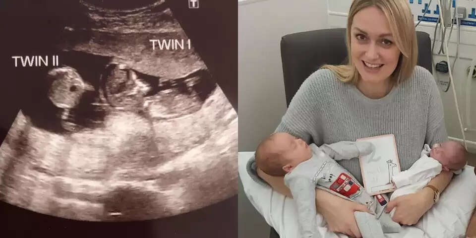 கடவுள் ஆசிர்வாதம்! கர்ப்பமாக இருக்கும் போதே மீண்டும் கர்ப்பமான பெண்! அதிர்ந்த மருத்துவர்கள்!