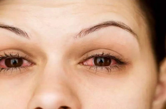 உஷார்!! ஒரே வாரத்தில் 40000 பேருக்கு மேல் பிங்க் ஐ பாதிப்பு!!