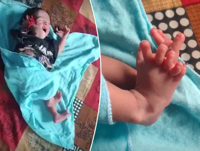 அட.. 26 விரல்களுடன் பிறந்த அதிசய பெண்குழந்தை!! வைரல் வீடியோ!!