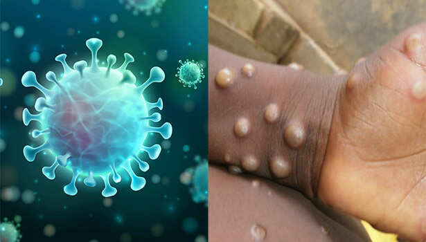 உஷார் மக்களே!! 1000ஐ தாண்டிய குரங்கு அம்மை பாதிப்புக்கள்!! உலக சுகாதார மையம் எச்சரிக்கை!!