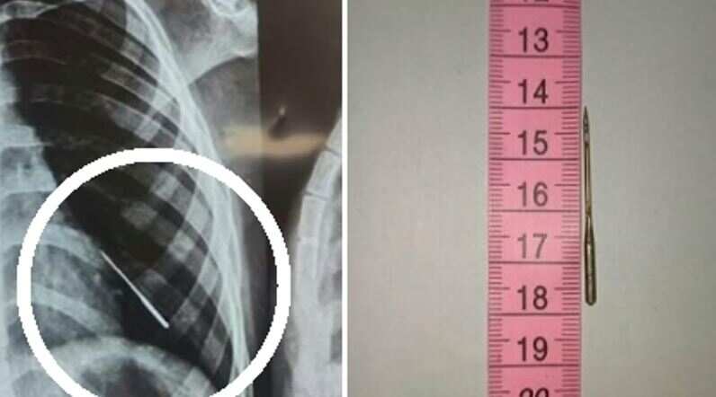 சிறுவனின் நுரையீரலில் இருந்த ஊசி.. அறுவை சிகிச்சை இல்லாமலே அகற்றி மருத்துவர்கள் சாதனை!