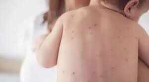 கேரளாவில் 160 பேருக்கு தட்டம்மை உறுதி!! கவனமா இருங்க மக்களே!!